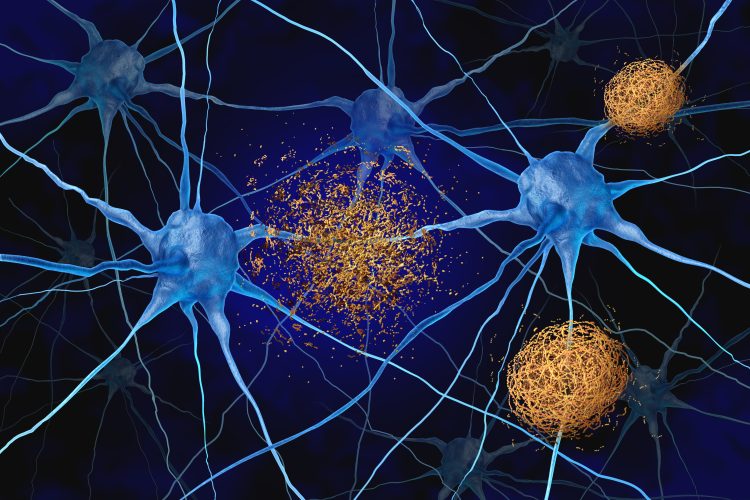 YENİ GELİŞTİRİLEN İLAÇ ALZHEİMER SÜRECİNİ DURDURABİLİR